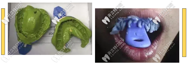 傳統(tǒng)牙齒矯正取模弊端