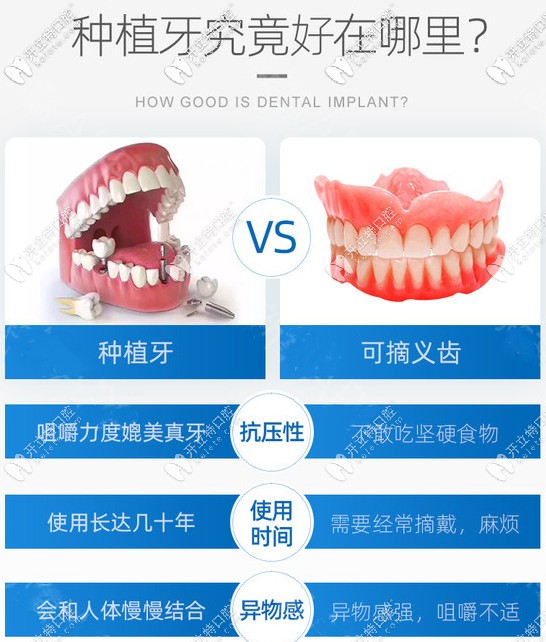 種植牙VS活動(dòng)假牙