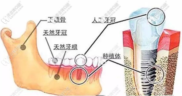 還在問西寧做一顆種植牙需要多少錢?這份收費(fèi)清單你沒看吧