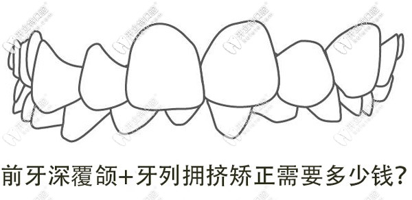 牙列擁擠+深覆合，想矯正牙齒做手術(shù)需要多少錢呢？