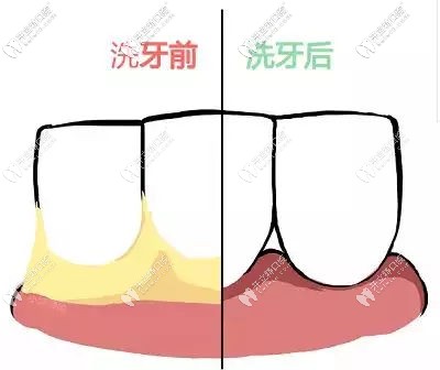 洗牙到底好不好？這個(gè)健康投資你可能沒算過