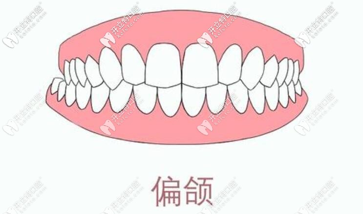 偏頜矯正