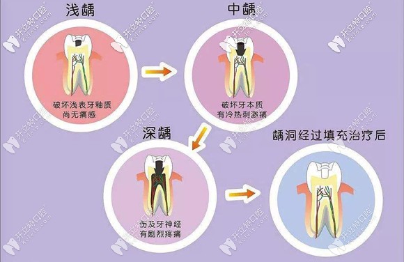 不同補牙技術(shù)也決定了補牙的收費