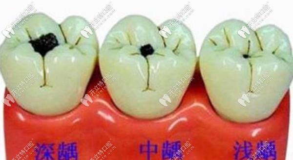 齲齒程度決定了補牙價格