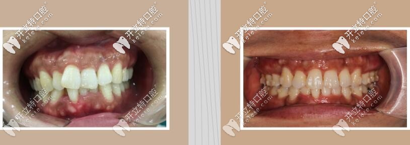 牙齒矯正前后照片