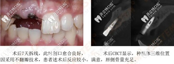 種植后拆線的照片