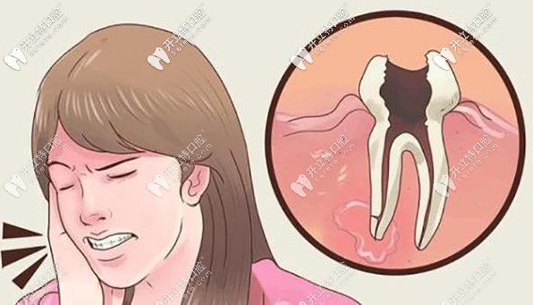 補牙洞疼不疼?超詳細的補牙過程來了解下