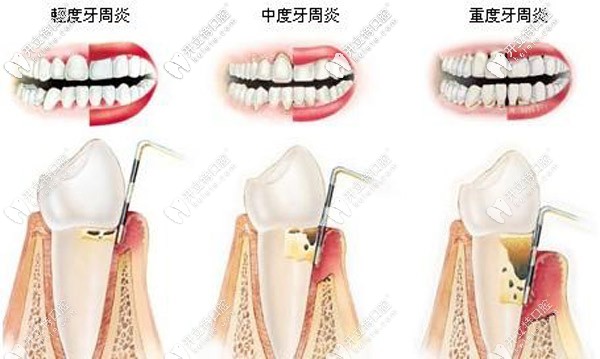 上海哪里有丹麥水冷激光治療，大概需要多少費用？