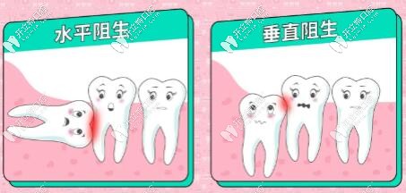 阻生智齒圖片