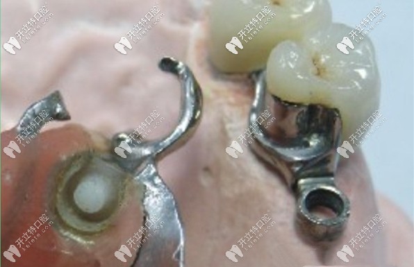 套筒冠和精密附件為什么很少有人做