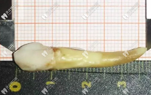 人的智齒較長有幾厘米，3.72厘米的牙齒你見過嗎？
