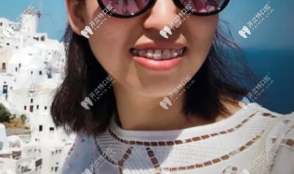 關于牙套臉的問題我來說說自己的看法