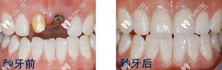 種牙前后對比