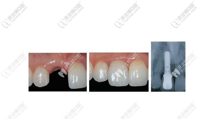 種植牙修復(fù)效果圖 種植牙修復(fù)效果圖