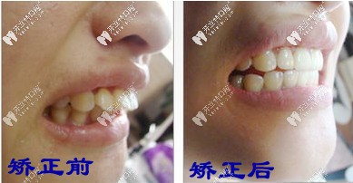 矯正前后對比