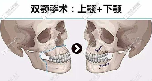 <!--<i data=20240703-sp></i>-->做骨性地包天矯正的費用是多少？