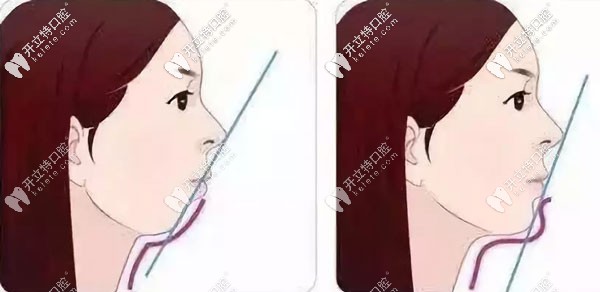 小孩子下巴后縮,通過正畸導(dǎo)下頜向前的較佳年齡是幾歲？