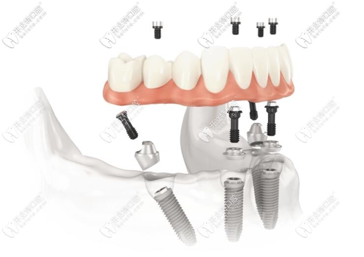 all-on-4/6全口種植牙