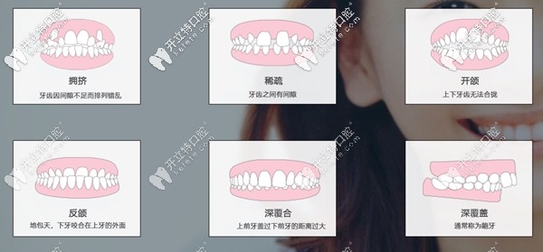 美恒矯正器適應癥