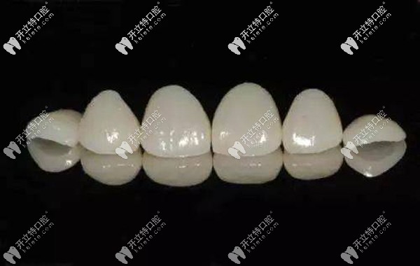 琥珀瓷牙貼面價格