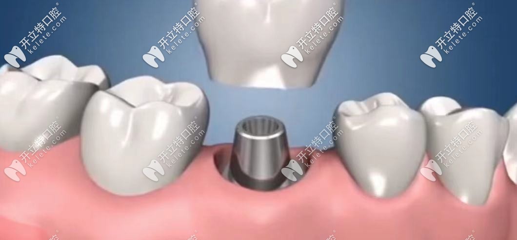 安裝基臺(tái)將牙冠和種植體連接固定，完成種植牙種植