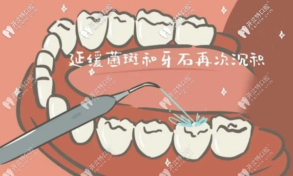 中級潔牙術(shù)的作用示意圖