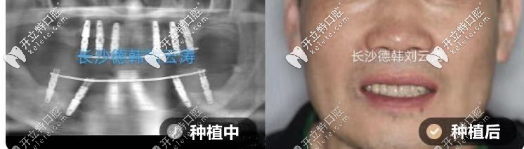 劉云濤：上半口all-on-6種植、下半口all-on-4種植