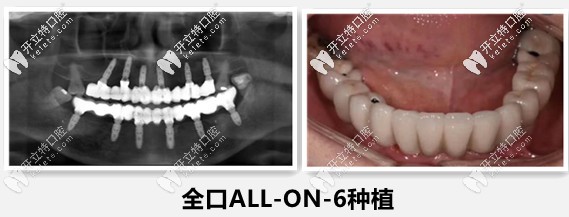 長(zhǎng)沙德韓劉云濤醫(yī)生——全口all-on-6種植牙