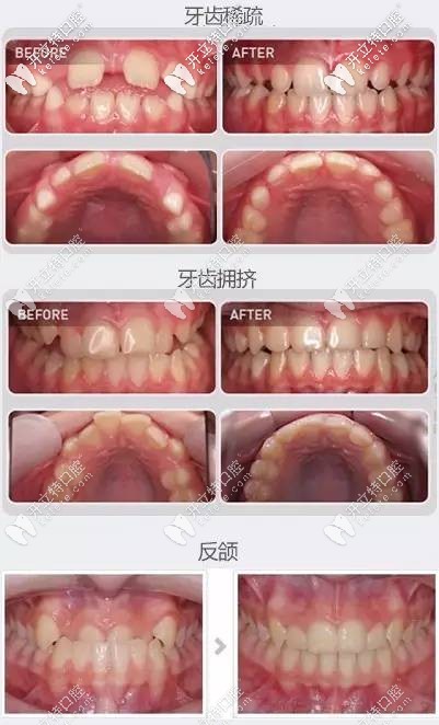 熊醫(yī)生-兒童早期牙齒矯正案例（牙齒不齊、反頜等癥狀）