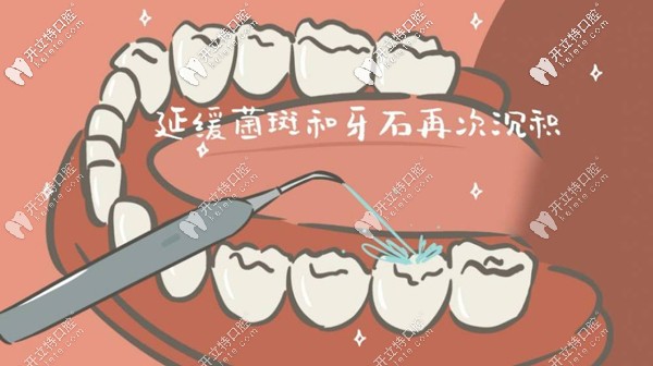 洗牙可延緩菌斑及牙石沉積
