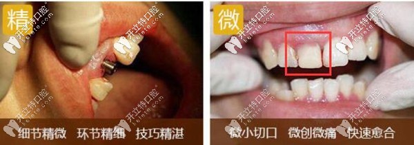 登特口腔德國(guó)種植牙醫(yī)生舒斯特的精準(zhǔn)微創(chuàng)種植牙案例
