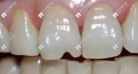 常吃堅(jiān)果會(huì)加速牙齒的磨耗，使牙齒出現(xiàn)裂紋