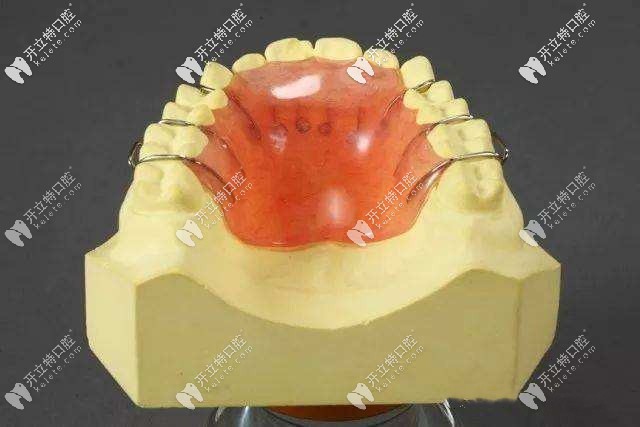 無(wú)功能平面牙合墊式上下活動(dòng)矯治器