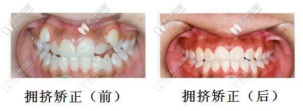 看看我的虎牙長(zhǎng)在牙齦上做矯正的效果吧,價(jià)格也不貴哦