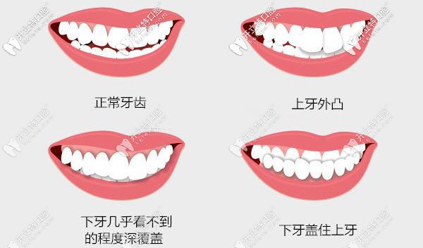 牙齒外凸、深覆合等情況都需要矯正