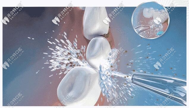 超聲波洗牙：有效清潔牙齒、保護(hù)牙齒健康