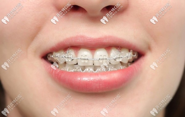 南寧悅美口腔成人極速矯正