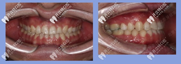 患者地包天矯正后