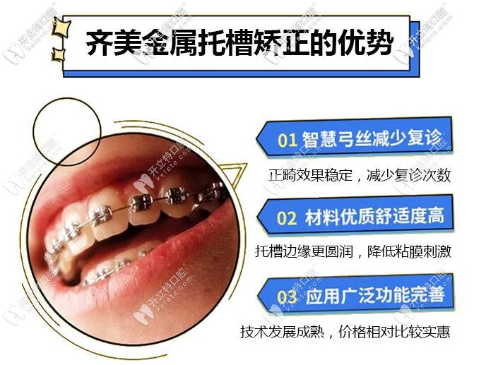 齊美口腔金屬托槽矯正優(yōu)勢(shì)