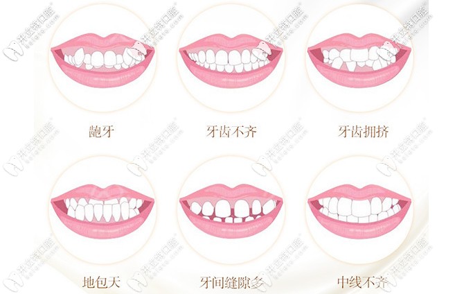 牙齒矯正的適應(yīng)癥