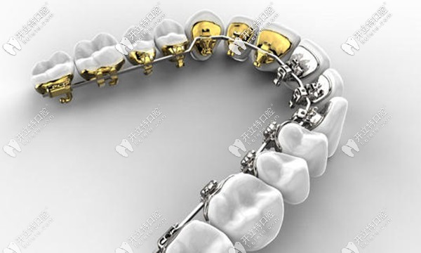 勁松口腔的舌側(cè)矯正技術(shù)