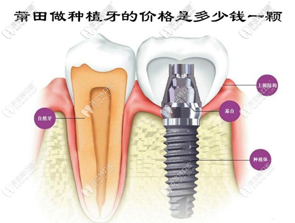 莆田做種植牙的價(jià)格是多少錢一顆