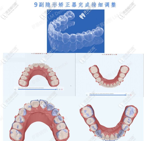 羅慕早期干預(yù)后需要9副透明牙套來完成精細(xì)調(diào)整