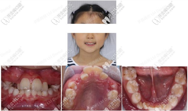 10歲女孩牙齒深覆合矯正前的照片