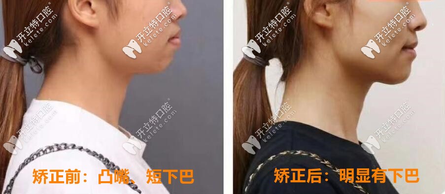 矯正前后對(duì)比照片：明顯有下巴，側(cè)顏好看