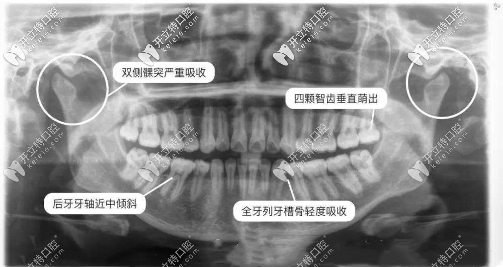 矯正牙齒/拔牙為啥要拍片？拍牙片輻射危害有多大