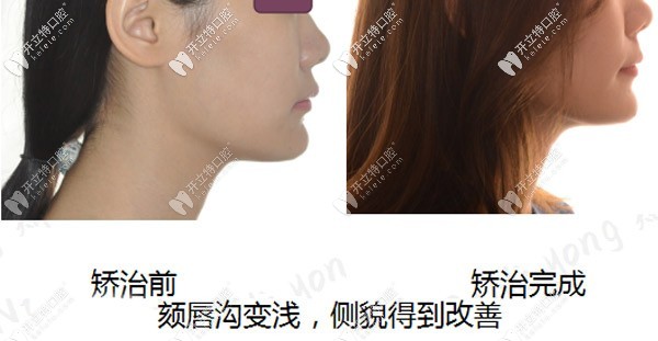 從隱適美矯正骨性深覆合的過程看,前后臉型變化確實不小