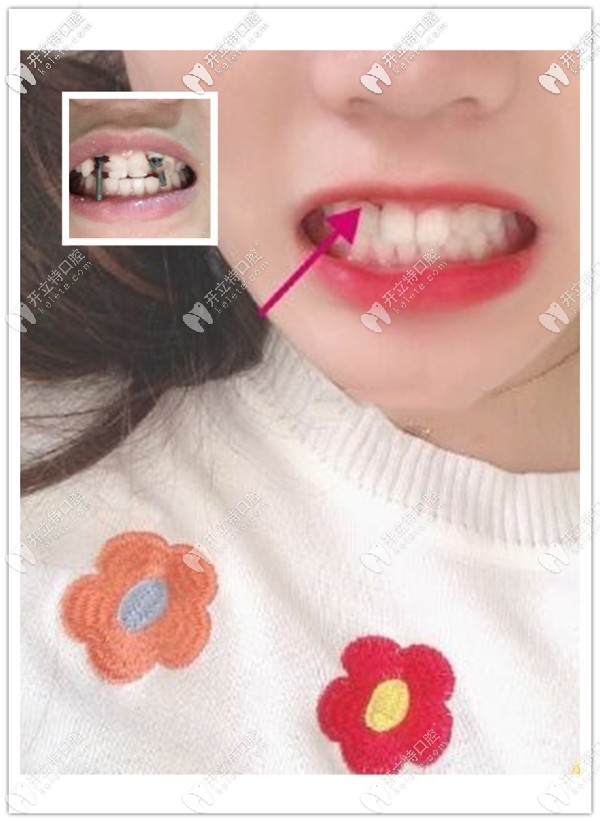 黃澤源醫(yī)生給缺兩顆側(cè)切牙女孩用德國ICX種植體修復(fù)成功啦