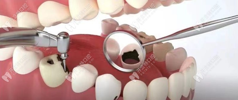 蛀牙不嚴(yán)重為什么要及時(shí)補(bǔ)牙，窩溝齲黑線是否要補(bǔ)牙呢？