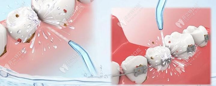 洗牙可是不會(huì)疼的，就是有點(diǎn)小麻